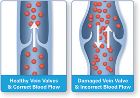 06_Healthy_vs_Diseased_Vein_Illustration